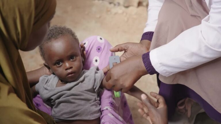 Aid cuts deepen Somalia’s unger crisis as more children battle severe malnutrition